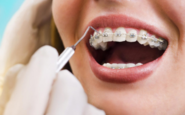 Orthodontic Treatment